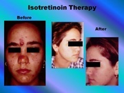 Isotretinoin Therapy pic