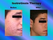 Isotretinoin Therapy pic