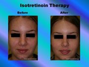 Isotretinoin Therapy pic