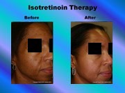 Isotretinoin Therapy pic