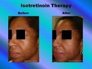 Isotretinoin Therapy pic