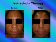 Isotretinoin Therapy pic