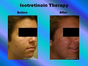 Isotretinoin Therapy pic