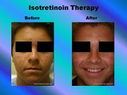 Isotretinoin Therapy pic