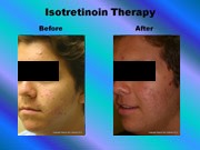 Isotretinoin Therapy pic