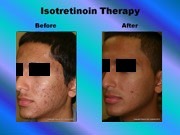 Isotretinoin Therapy pic