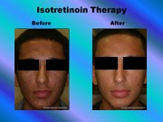 Isotretinoin Therapy pic