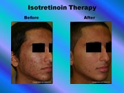 Isotretinoin Therapy pic