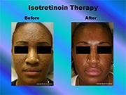 Isotretinoin Therapy pic