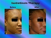 Isotretinoin Therapy pic