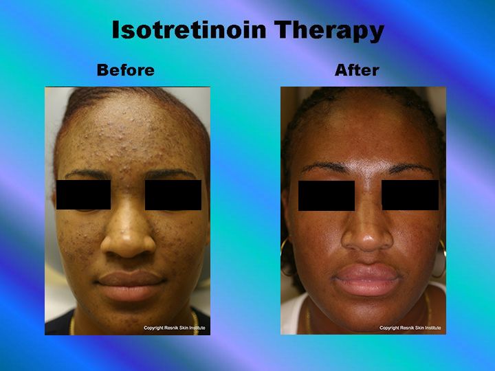 Isotretinoin Therapy pic