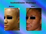 Isotretinoin Therapy pic