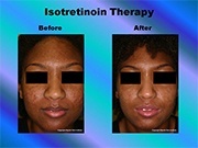 Isotretinoin Therapy pic