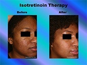 Isotretinoin Therapy pic
