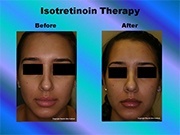 Isotretinoin Therapy pic