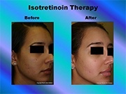 Isotretinoin Therapy pic