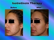 Isotretinoin Therapy pic
