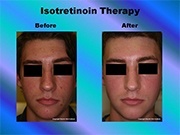 Isotretinoin Therapy pic