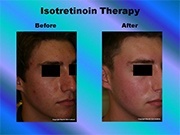 Isotretinoin Therapy pic