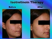 Isotretinoin Therapy pic