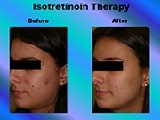 Isotretinoin Therapy pic
