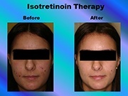 Isotretinoin Therapy pic