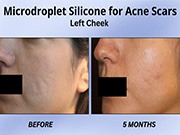 Isotretinoin Therapy pic