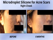 Isotretinoin Therapy pic